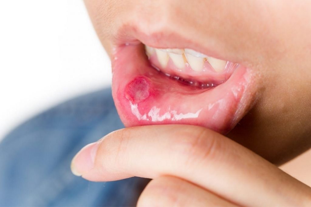 Quais são os sintomas da boca seca