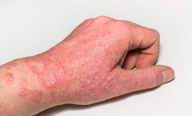Dermatite Atópica: Causas, Sintomas e Tratamentos Eficazes Dermatite Atópica: Causas, Sintomas e Tratamentos Eficazes