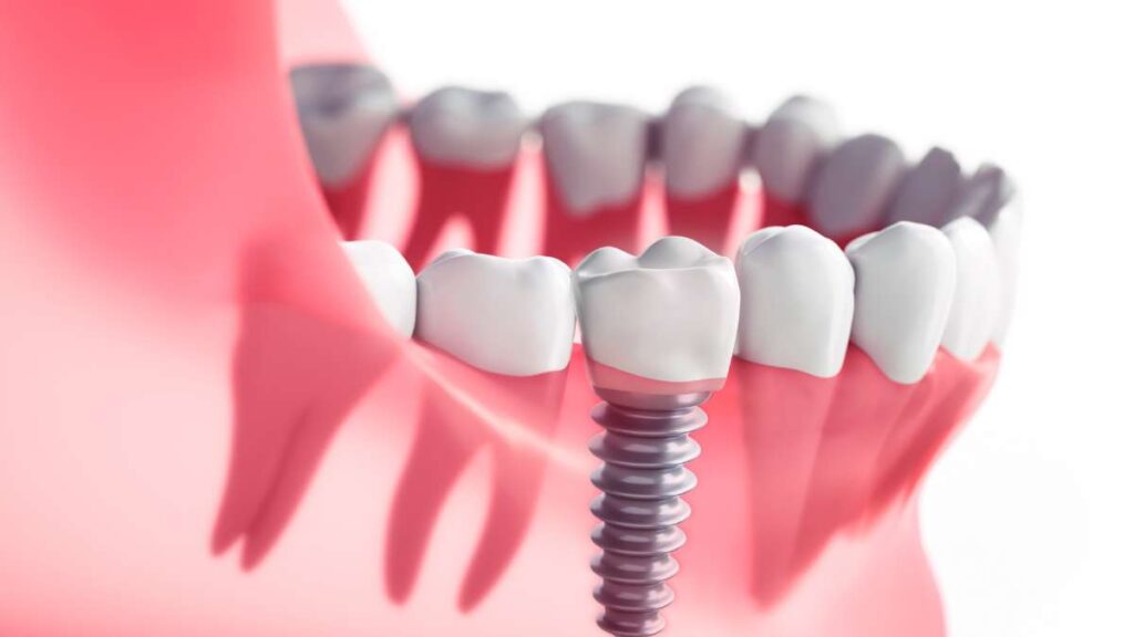 Como funciona o implante dentário: Guia completo