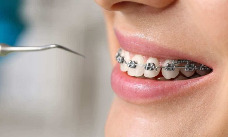 Como aliviar a dor do aparelho nos primeiros dias