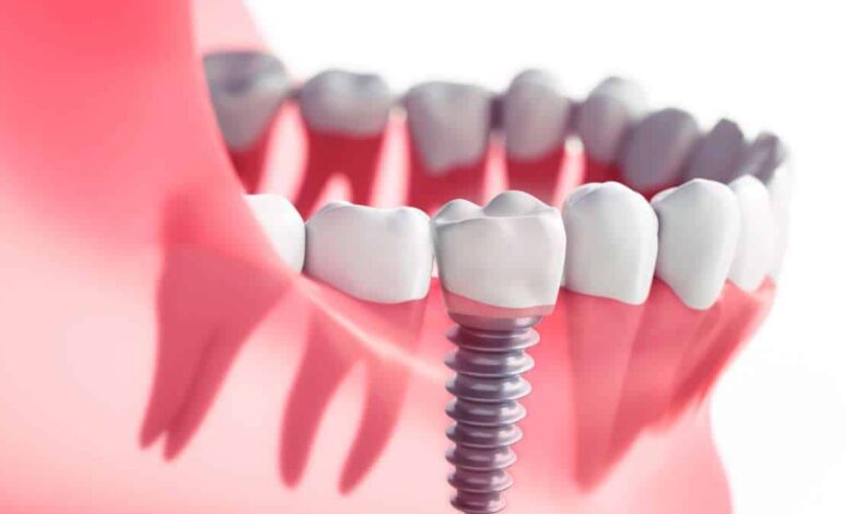 Como funciona o implante dentário: Guia completo Como funciona o implante dentário: Guia completo